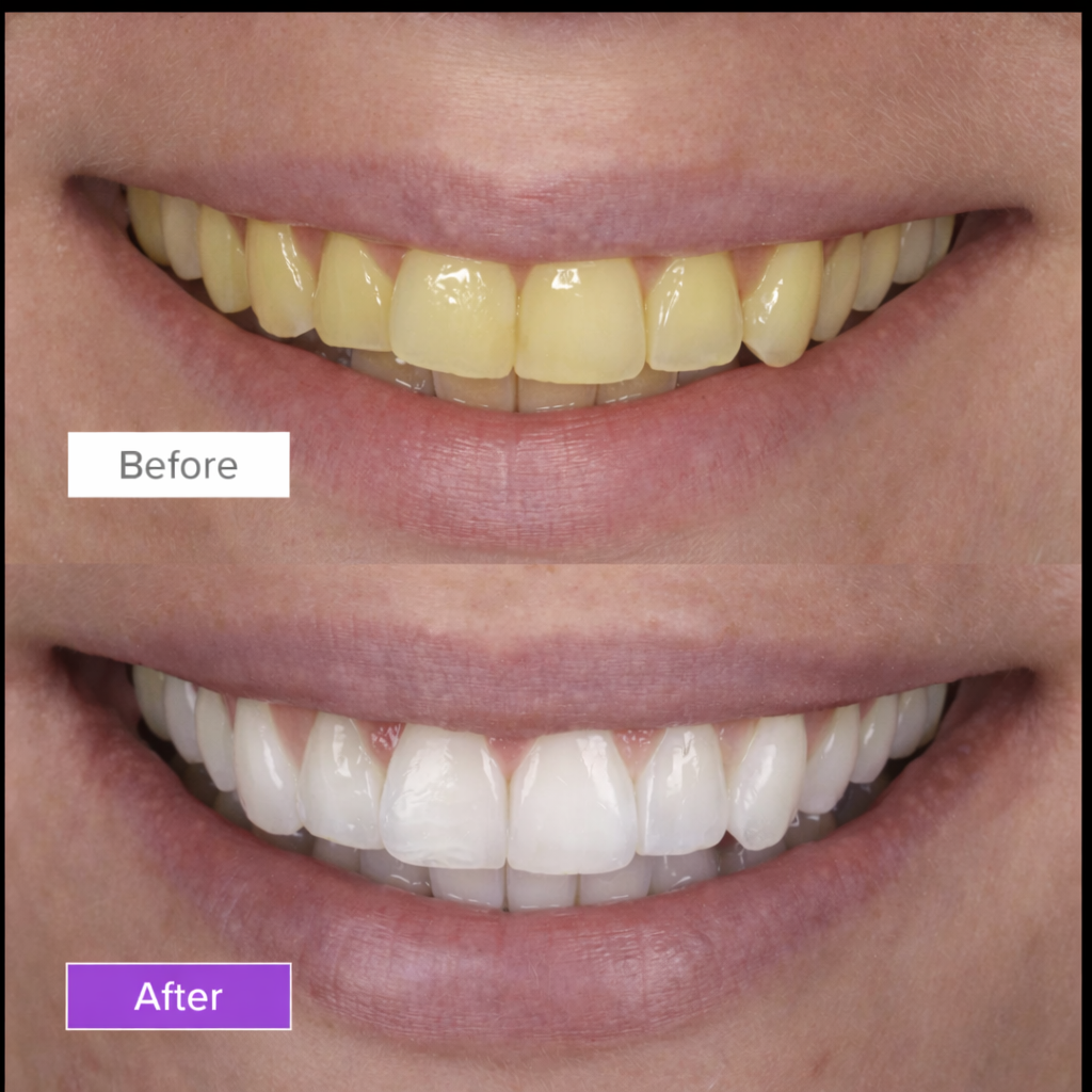 Dr. Smile - Purple Strips